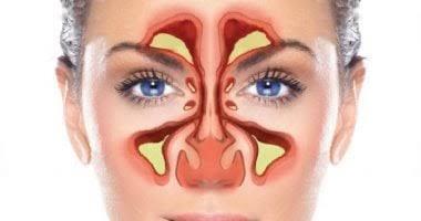 تعرف على أسباب تهيج الجيوب الأنفية