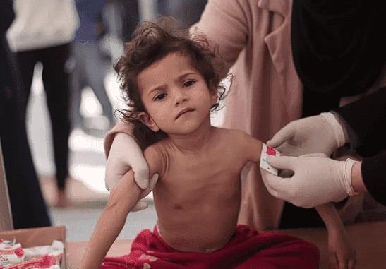 "يونيسف": 9 آلاف طفل دون 5 سنوات في غزة يعانون سوء تغذية حاد