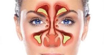 تعرف على أسباب تهيج الجيوب الأنفية