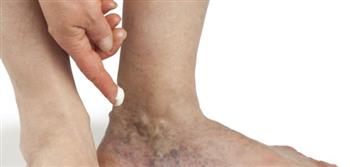 انتبه ...أعراض تدل على إكزيما الدوالي