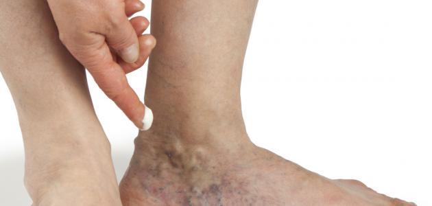 انتبه ...أعراض تدل على إكزيما الدوالي