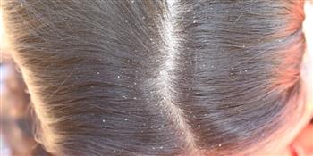 أسباب زيادة قشرة الشعر في الشتاء