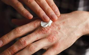 لمن تعاني من الأكزيما في الشتاء.. إليك هذه النصائح