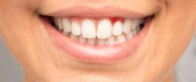 الحل الأمثل لنزيف اللثة أثناء غسل الأسنان