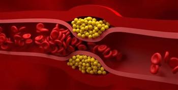 علامات تدل على ارتفاع الدهون الثلاثية