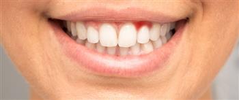 الحل الأمثل لنزيف اللثة أثناء غسل الأسنان