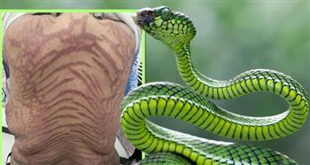 بسبب استعمال دواء شعبي.. صينية تتحول بشرتها إلى جلد ثعبان