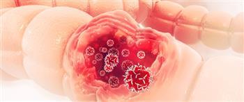 كيف تؤثر السكريات على سرطان القولون؟