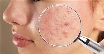 للتخلص من حب الشباب.. اتبعي تلك الخطوات البسيطة