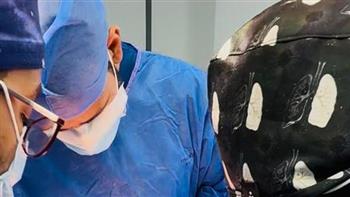 نجاح عملية نادرة لاستئصال ورم ضخم يزن 6 كجم من جدار الصدر بمستشفى السلام في بورسعيد