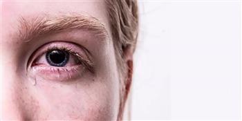 5  أسباب وراء حرقة العين