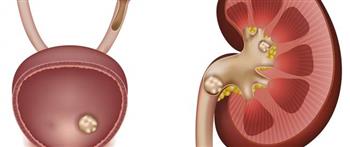 نصائح لعدم تكرار الإصابة بحصوات الكلى