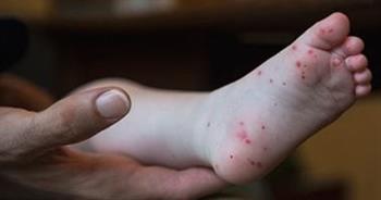 الحمى القلاعية.. الأعراض والوقاية
