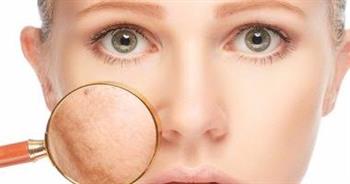 أسباب ظهور الكلف على بشرتك