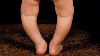 تعرف على أعراض الكساح عند الطفل