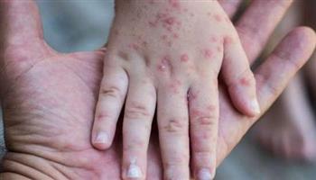 انتبه ..الجديرى المائى موسمه الشتاء