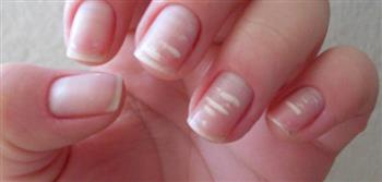 انتبه...البقع البيضاء على أظافرك تدل على هذه الأمراض