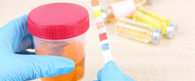 4  أسباب وراء تغير لون البول