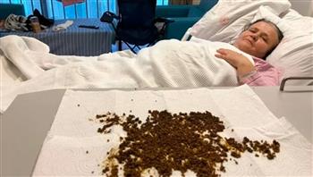 لن تصدق.. استخراج 20 ألف حصوة من مرارة مسنّة 