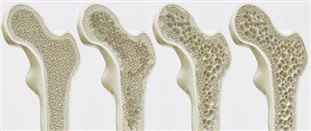 تعرفي على مضاعفات الإصابة بهشاشة العظام