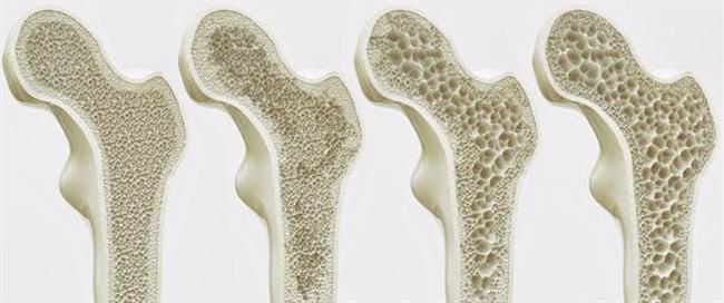 تعرفي على مضاعفات الإصابة بهشاشة العظام