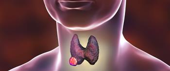 انتبه.. علاقة الكحة بسرطان الغدة الدرقية