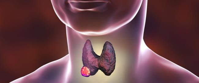 انتبه.. علاقة الكحة بسرطان الغدة الدرقية