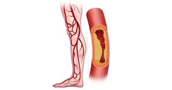 أعراض انسداد شرايين القدم