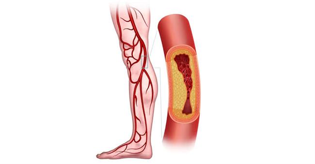 أعراض انسداد شرايين القدم