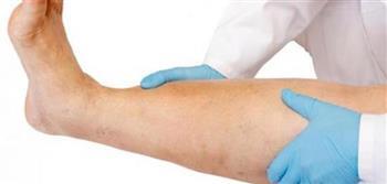 علامات وجود جلطة في الساق وأعراضها