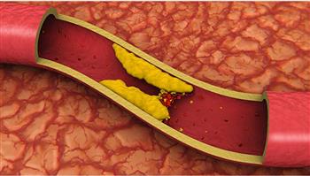 نظام غذائي لخفض نسبة الكوليسترول الضار