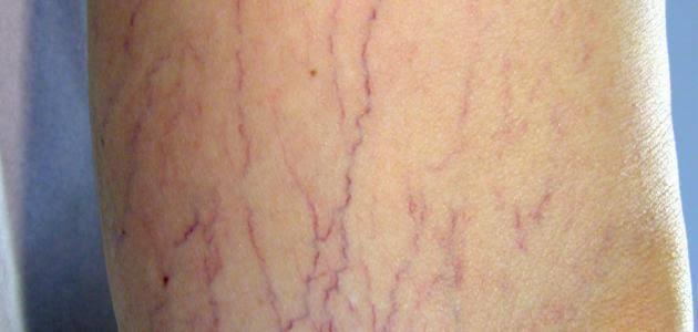 بهذه الطريقة يمكن التحكم فى أعراض دوالي الساقين