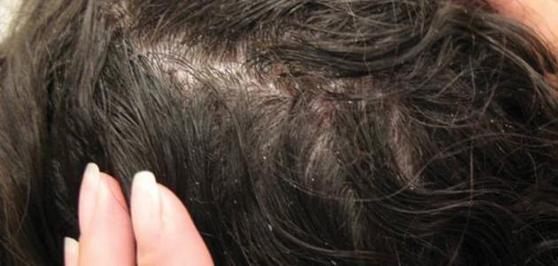 ابتعد عن استخدام هذه الأشياء حتي لا تُصاب بالقمل 