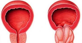 أعراض تضخم البروستاتا