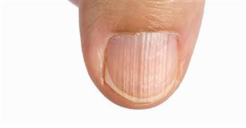 انتبه ..خطوط الأظافر تستدعي القلق في هذه الحالة