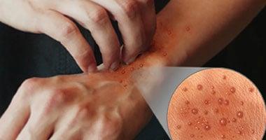 في الشتاء..أسباب حساسية البرد