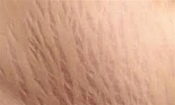 تعرفي على أسباب ظهور علامات تمدد الجلد خلال الحمل وطرق الوقاية منها