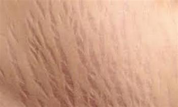 تعرفي على أسباب ظهور علامات تمدد الجلد خلال الحمل وطرق الوقاية منها