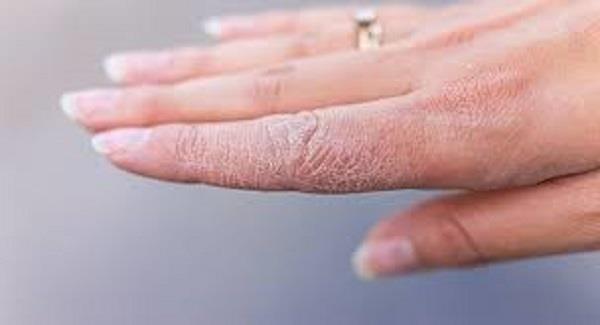 «الصحة» تقدم طرق لحماية نفسك من جفاف الجلد في فصل الشتاء