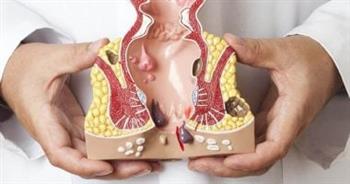 3  نصائح لتخفيف ألم البواسير