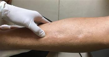 هذه هي أعراض احتباس السوائل في الجسم