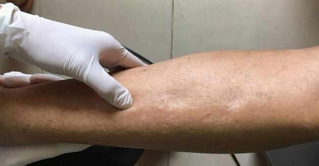 هذه هي أعراض احتباس السوائل في الجسم