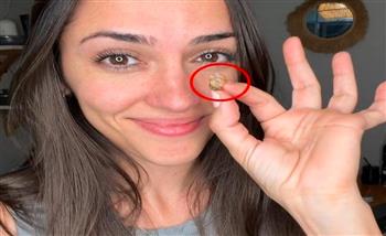 35 عامًا من المعاناة.. سيدة تتنفس بشكل طبيعي للمرة الأولى