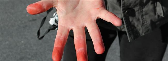 ماذا تعرف عن لسعة البرد؟ 