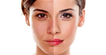 تغير لون البشرة أحد أسباب نقص فيتامين ب١٢