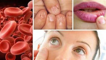 علامات تدل على أنيميا نقص الحديد