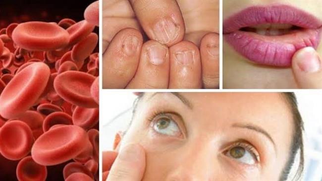 علامات تدل على أنيميا نقص الحديد