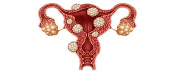 احذر ..مضاعفات الورم الليفي في الرحم