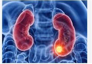 3 أخطاء يومية تهدد وظائف الكليتين وتسبب فشلاً كلويًا قبل سن الأربعين