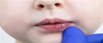 تعرف على اسباب تشققات وجفاف الفم عند الرضع